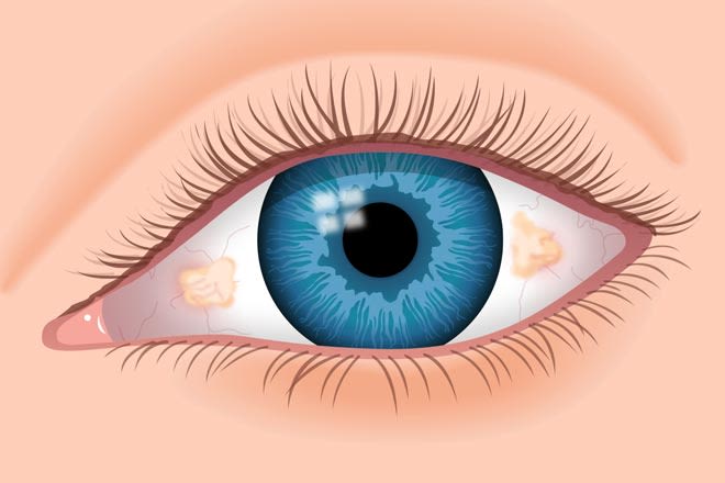 illustration of an eye with pinguecula