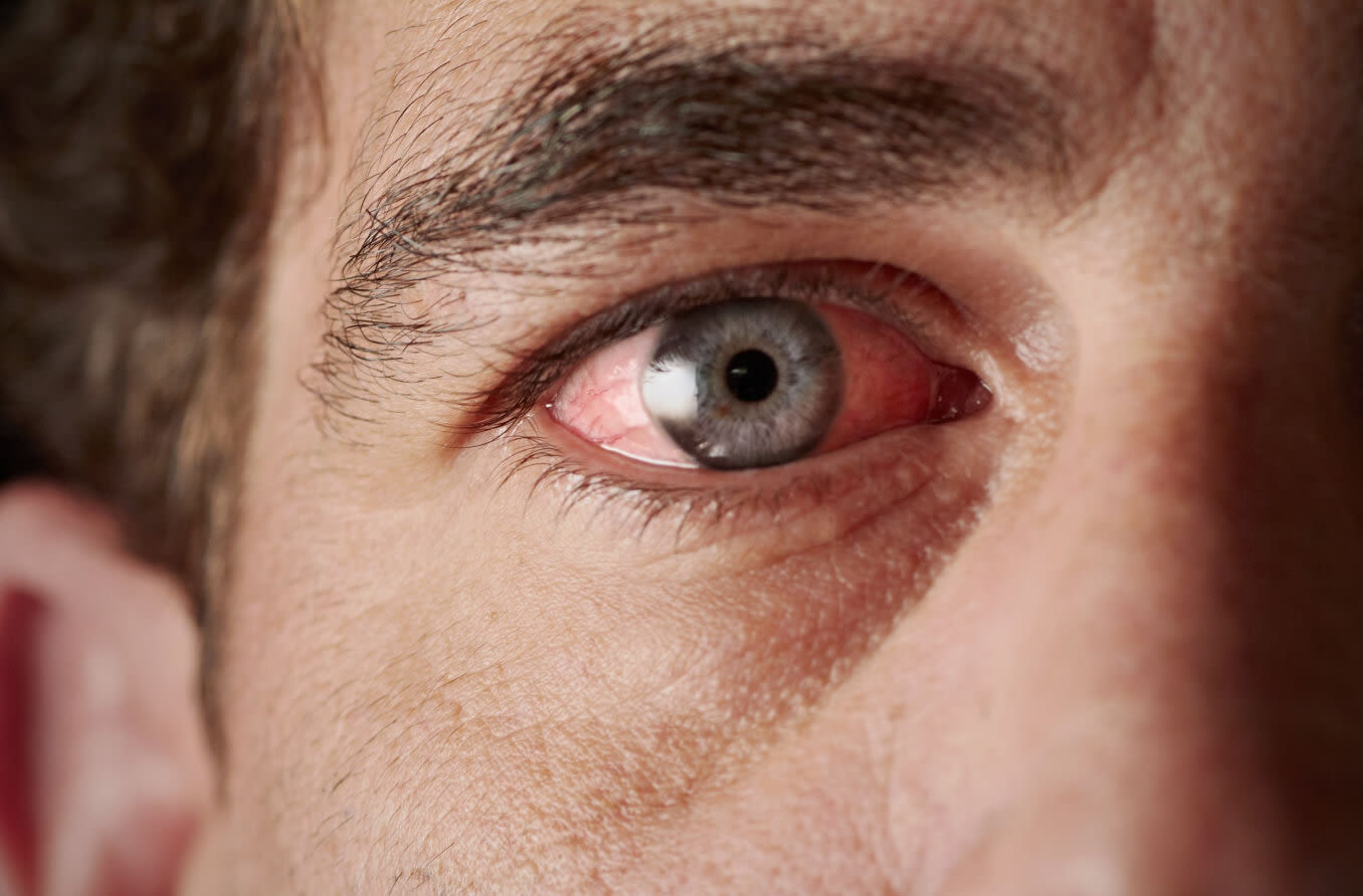 Крупный план женщины с синдромом красных глаз