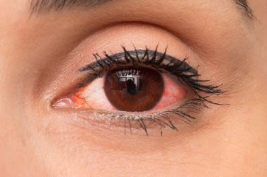 Close-up of a woman with red eye condition