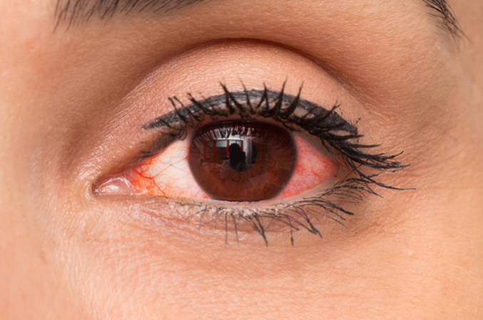 close-up of a woman with red eye 