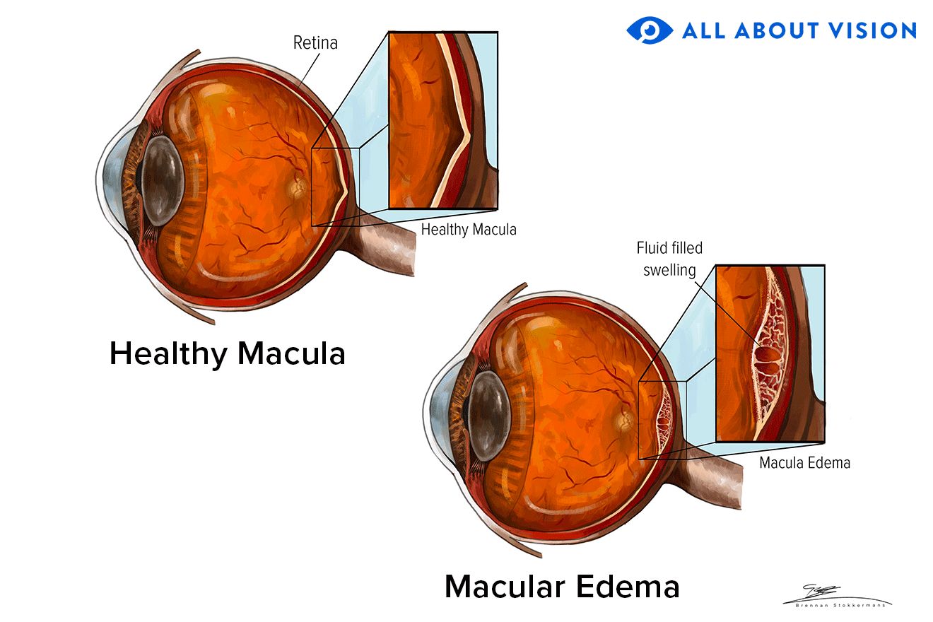 Comparison between a healthy macula and macular edema