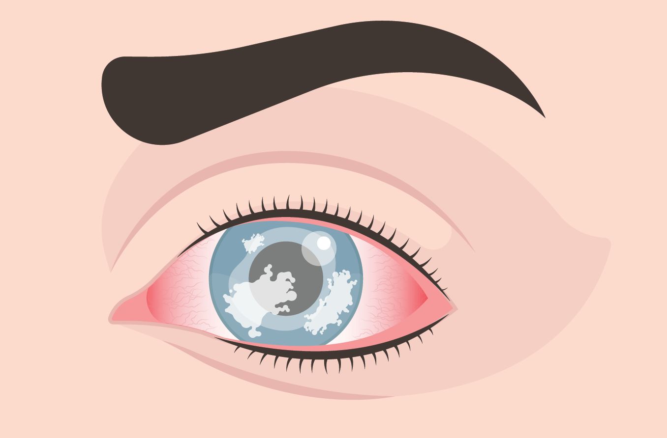 illustration of corneal dystrophy of the eye