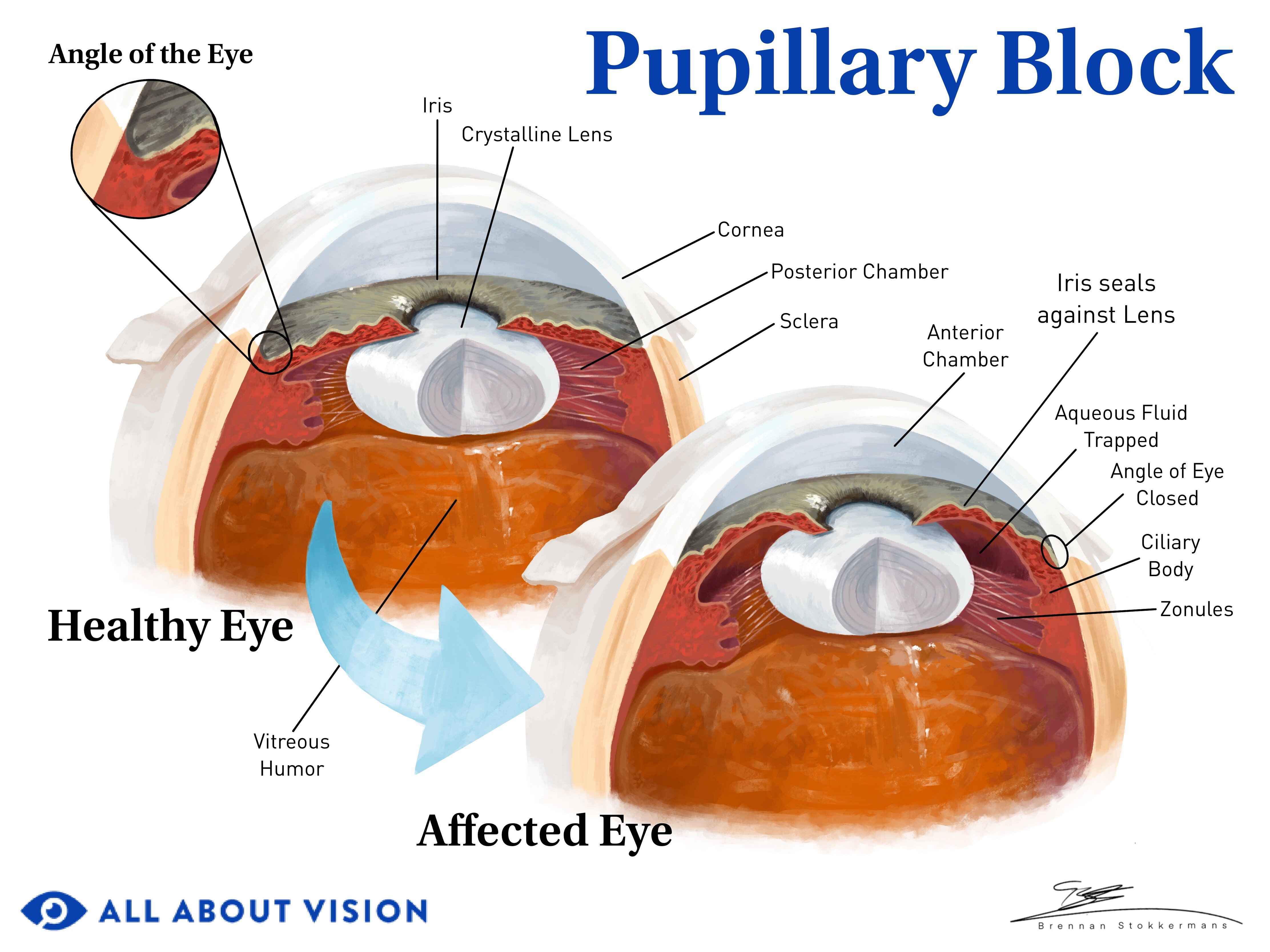 What Is Secondary Glaucoma