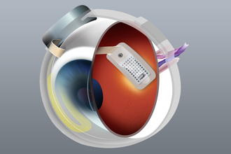 Argus II Retinal Prosthesis System 2 