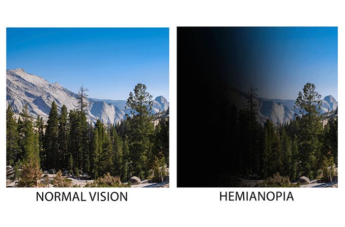 side by side mountainscape images of normal vision vs. vision with hemianopia