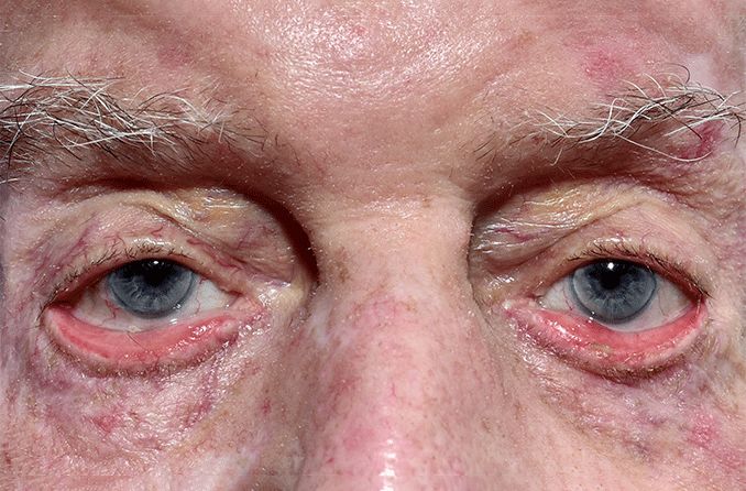 close up of an elderly man's eyes with ectropion