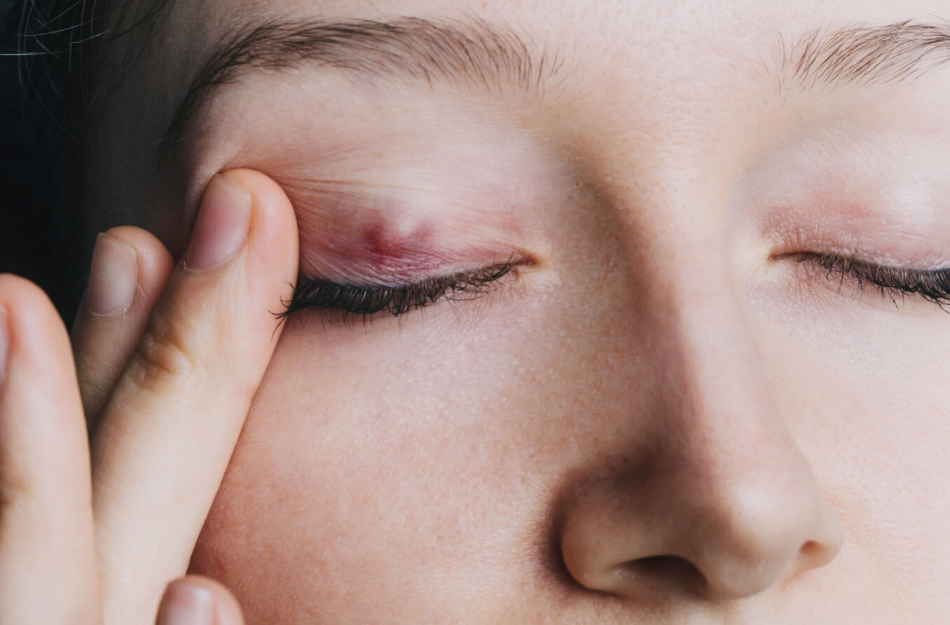 Young girl shows a chalazion on the eyelid closeup.