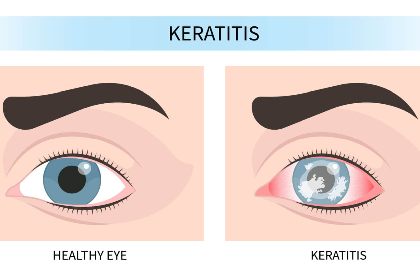 Neurotrophic keratitis of the eye, pink, inflamed cornea.