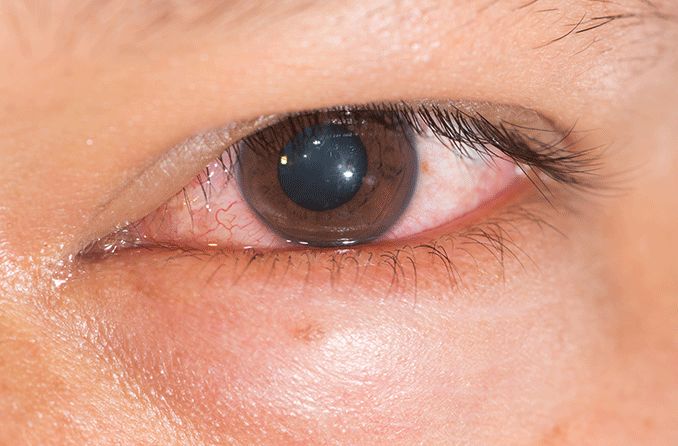 closeup de quemose do olho