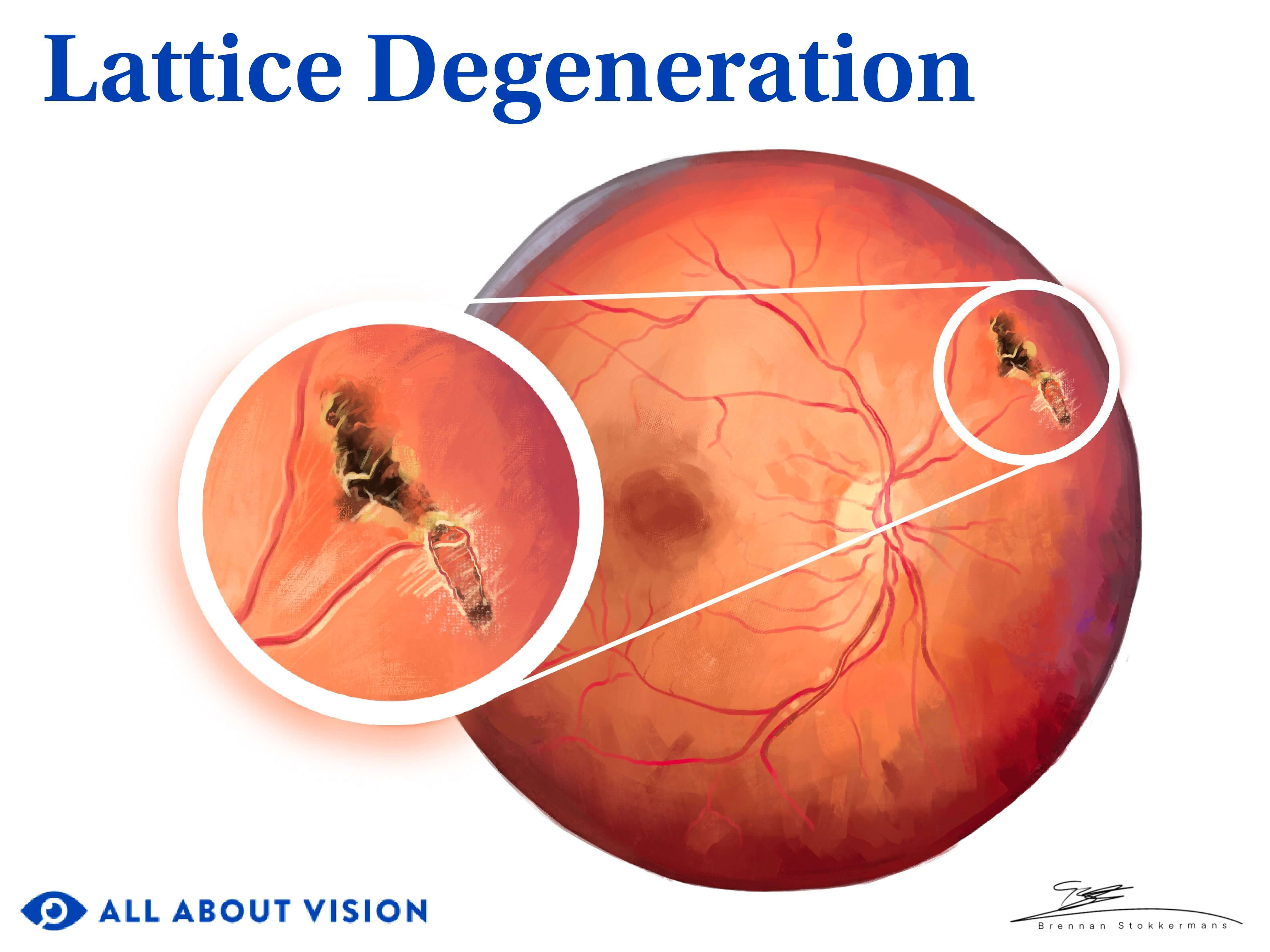 Medical illustration of lattice degeneration of the eye.