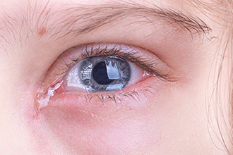 White Stringy Mucus in Eye - CorneaCare
