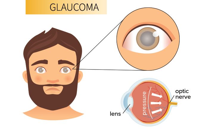 illustration of a man with glaucoma