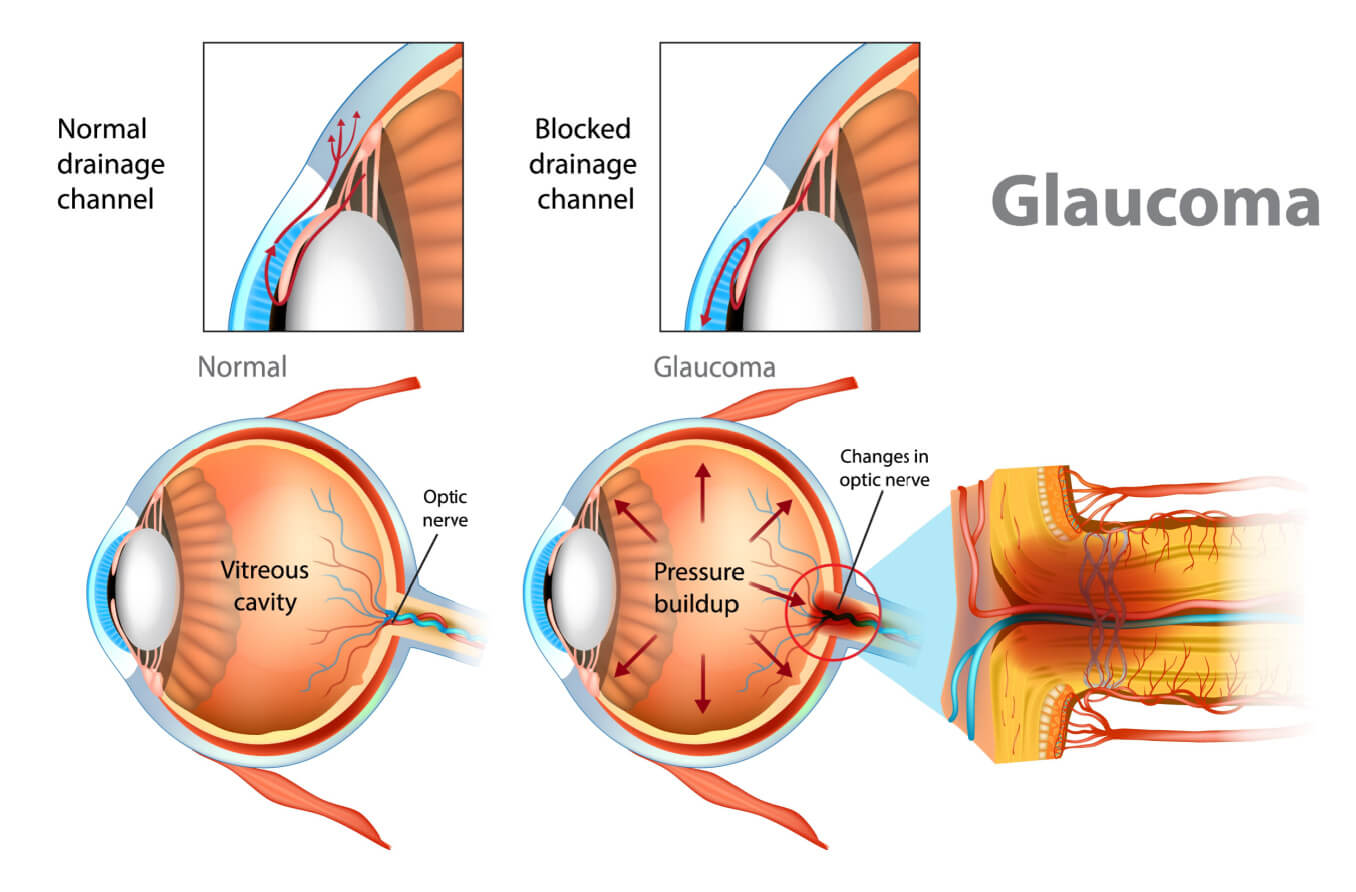 Illustration of a normal eye v eye with glaucoma.