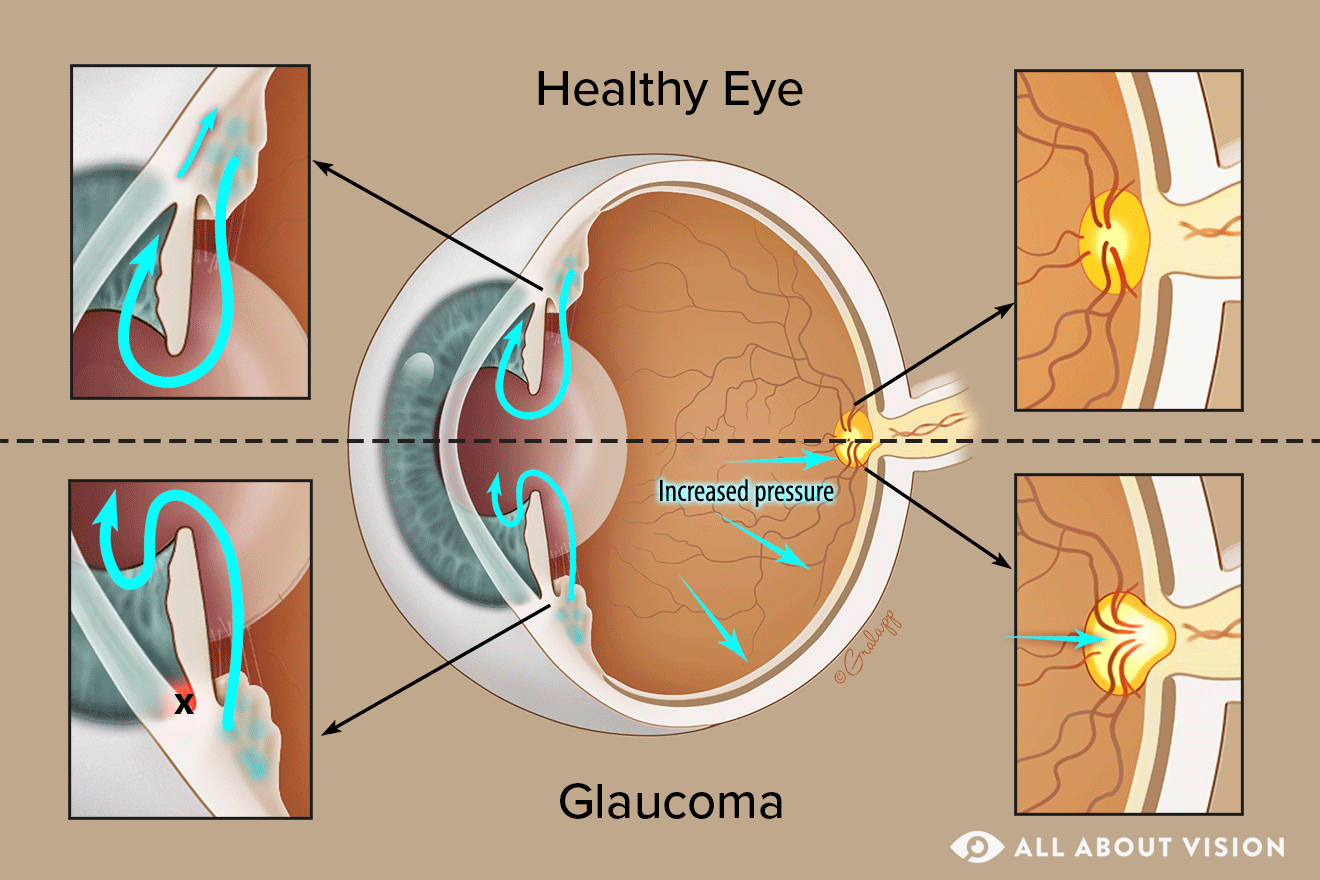 glaucoma vs healthy eye illustration