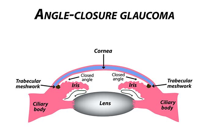 illustration of closed angle glaucoma