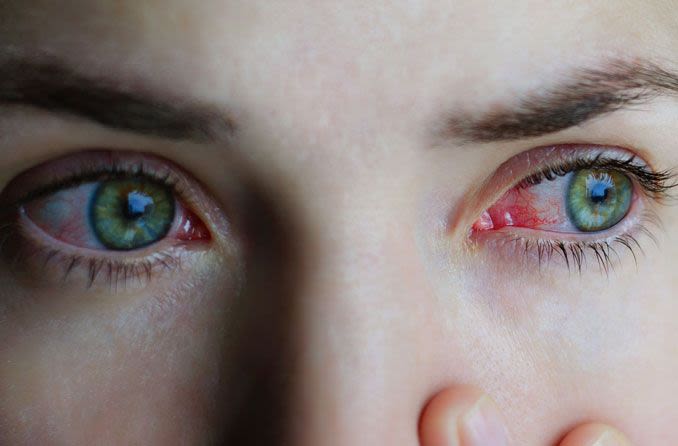 Irritated allergy eyes