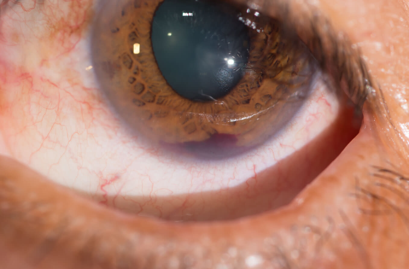 在眼睛的Subconjunctival出血 库存照片. 图片 包括有 早餐, 燃烧的, 丽蝇, 内眼膜 - 104141376