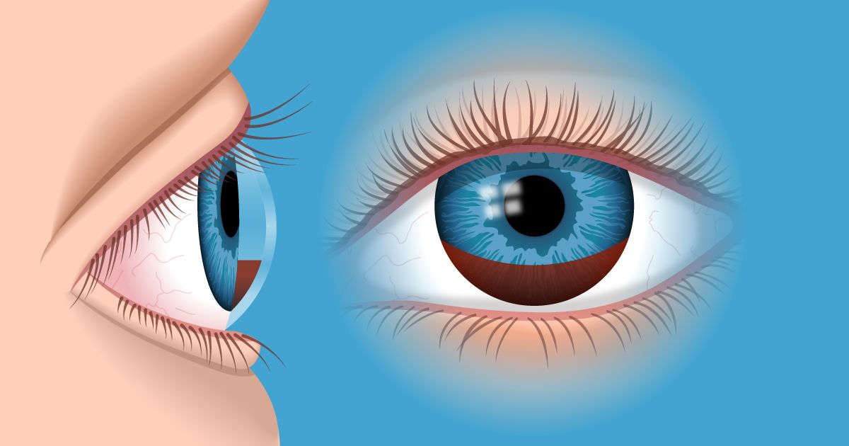 hyphema of the eye