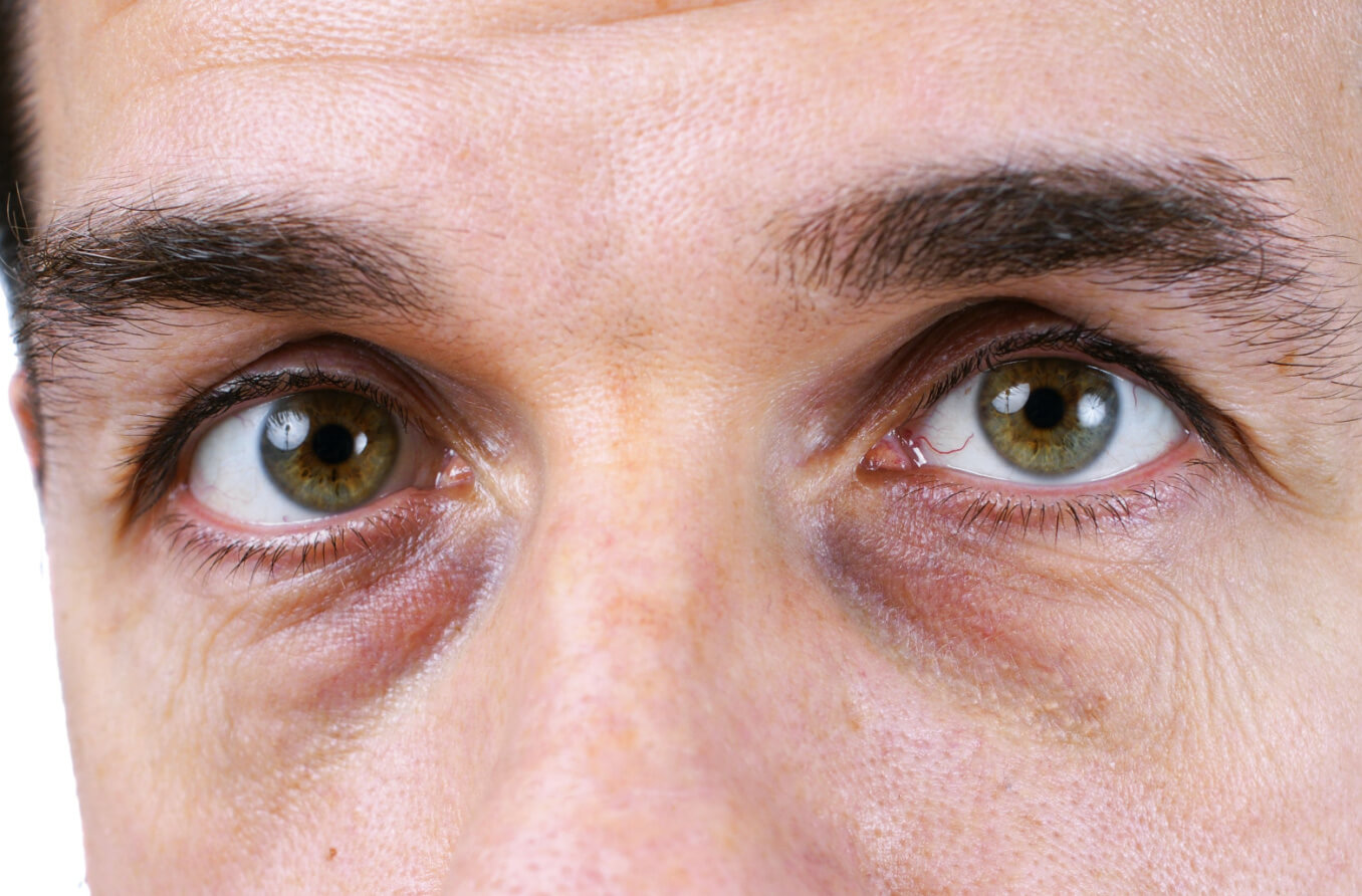 Dark Circles Under The Eyes: Causes & Treatments