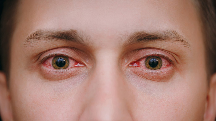 19 red eye causes