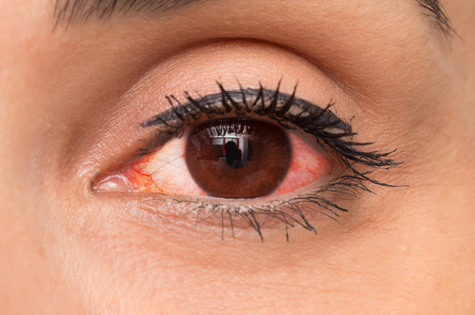 Closeup of a woman's red, bloodshot eye - India