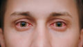 Hombre Con Ojos Rojos