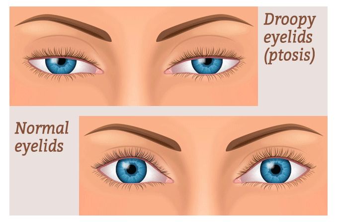 illustration of droopy eyelids (ptosis) vs. normal eyelids