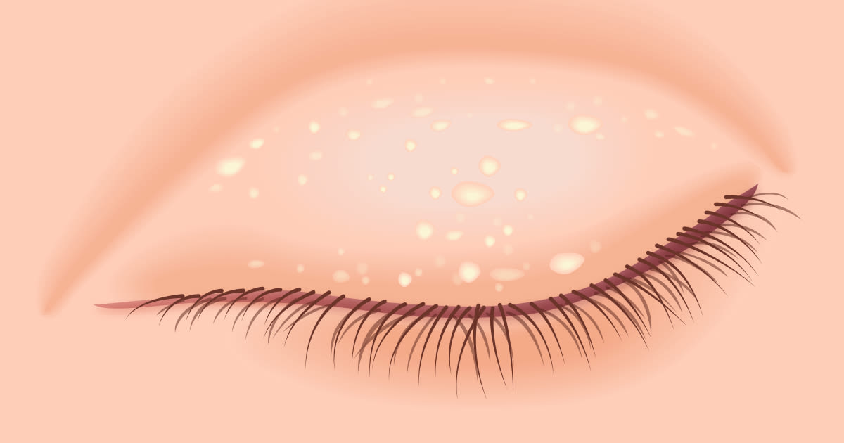 illustration of milia condition