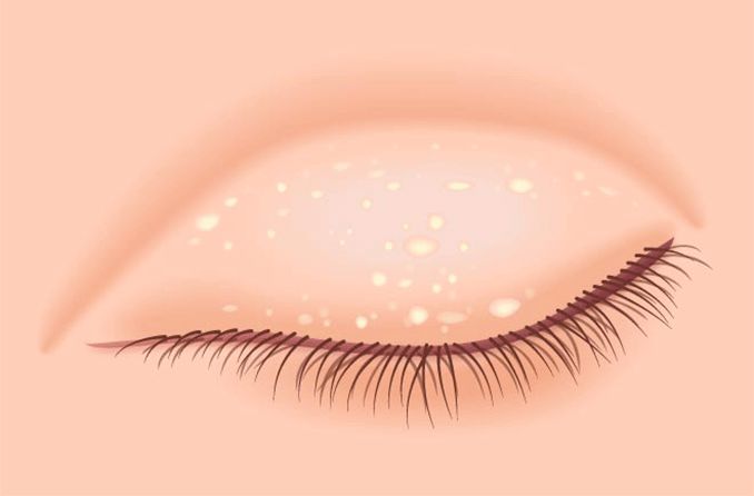 Illustration of milia on the eye lid.