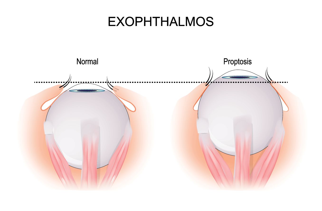 illustration comparing a healthy eyeball vs. an eyeball with proptosis (exophthalmos)