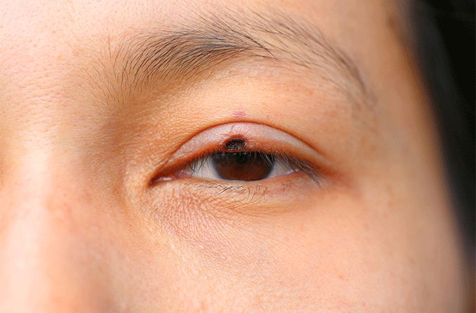 closeup of a person with possible eyelid cancer