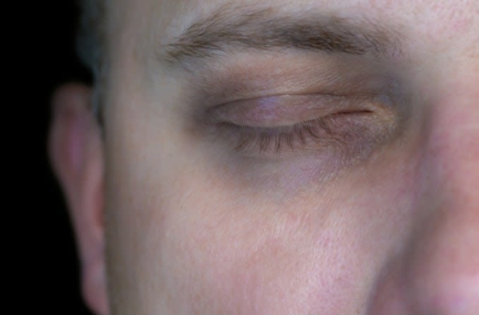 Close-up of a man who has dark undereye circles.