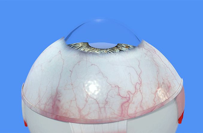 3D image of an eyeball displaying normal cornea without corneal neovascularization