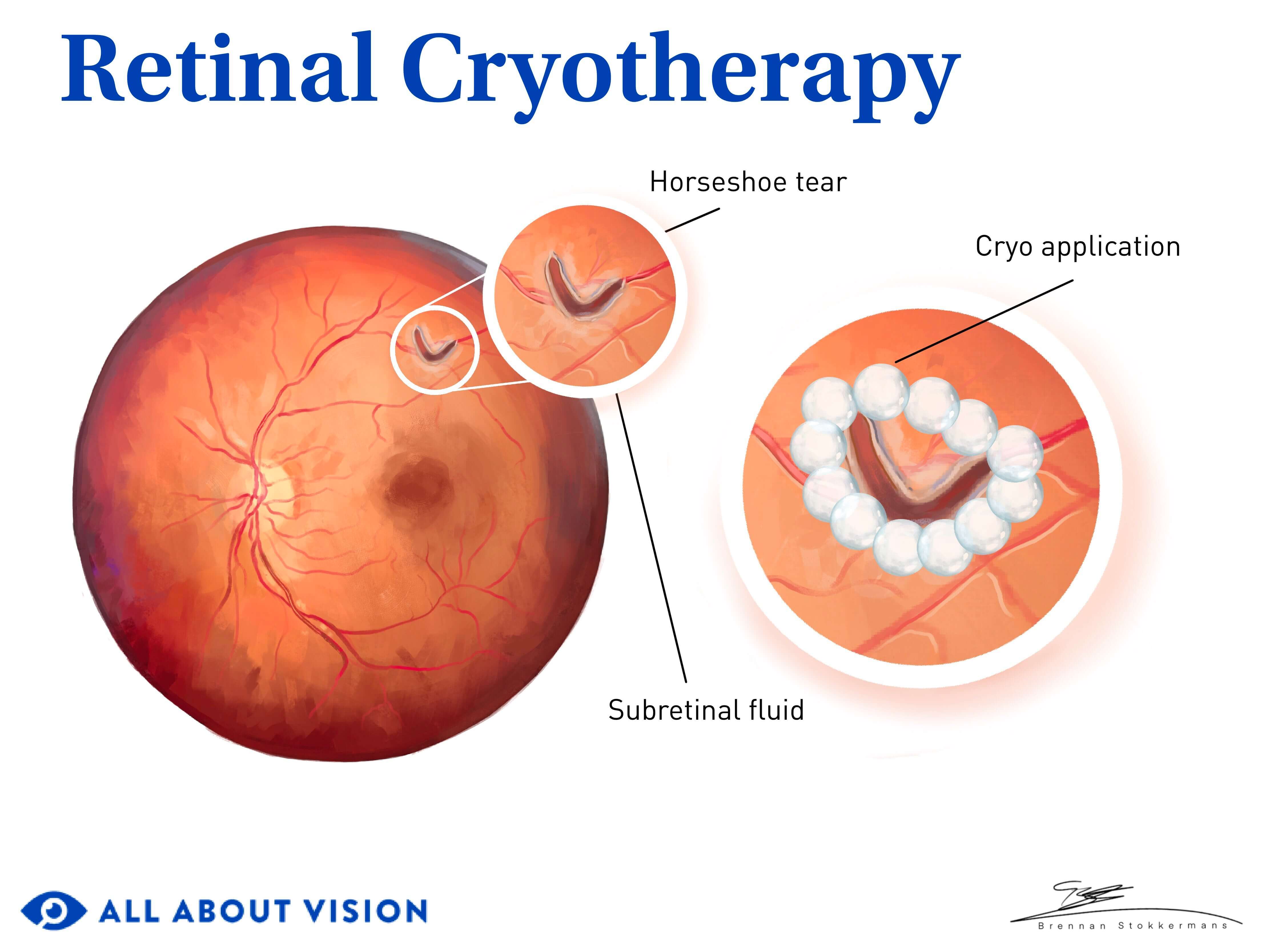 Illustration of retinal cryotherapy procedure.