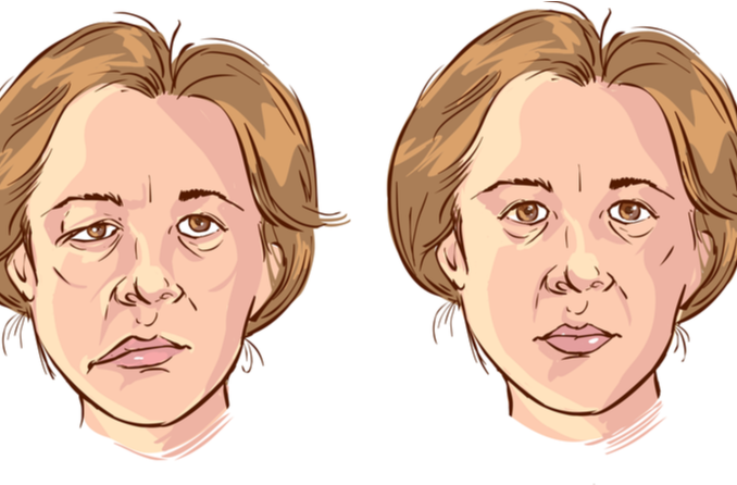 Paralysie Faciale (ou Paralysie De Bell) : Quelles Conséquences Sur L’œil