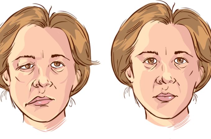 Bell's Palsy'nin İllüstrasyonu