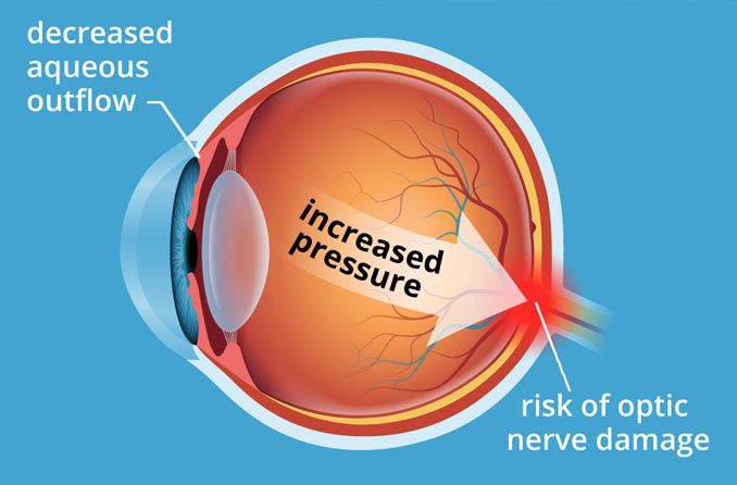 Intra-ocular pressures in both eyes  Download Table