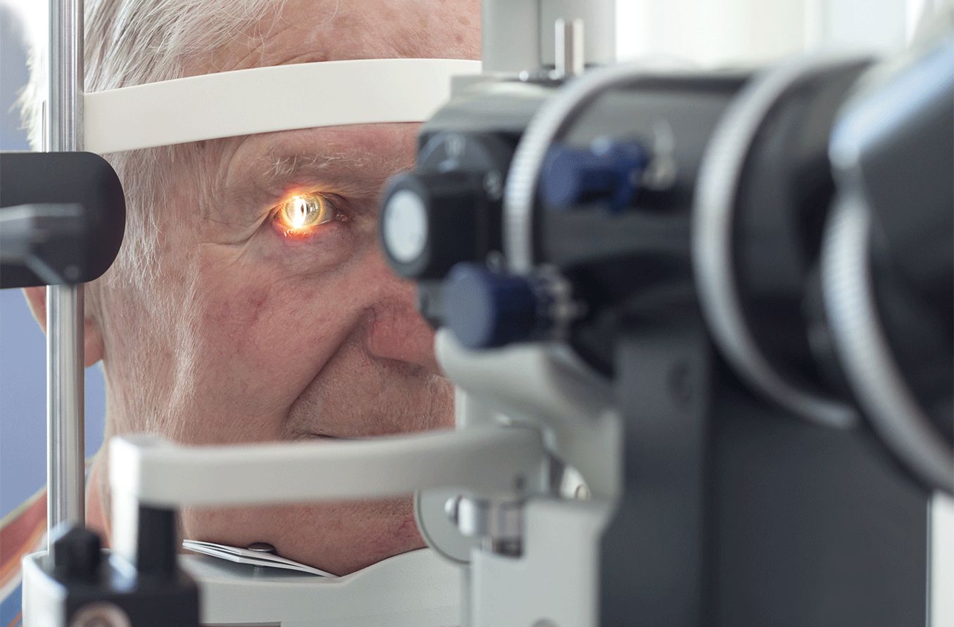 Eye doctor performing slit lamp exam on older man in order to detect conjunctivochalasis
