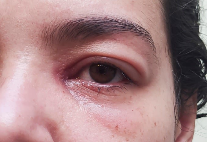 persona con párpado hinchado
