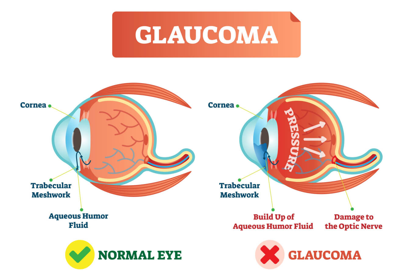 Trabecular Meshwork depiction in a healthy eye v an eye with glaucoma.