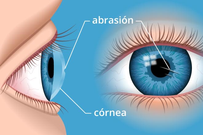 Ilustração de uma abrasão na córnea