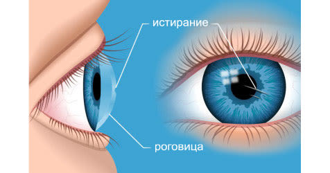 Иллюстрация ссадины роговицы