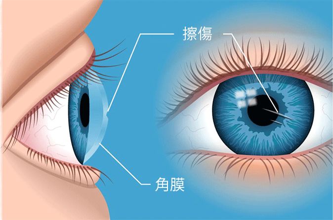 角膜擦伤的插图