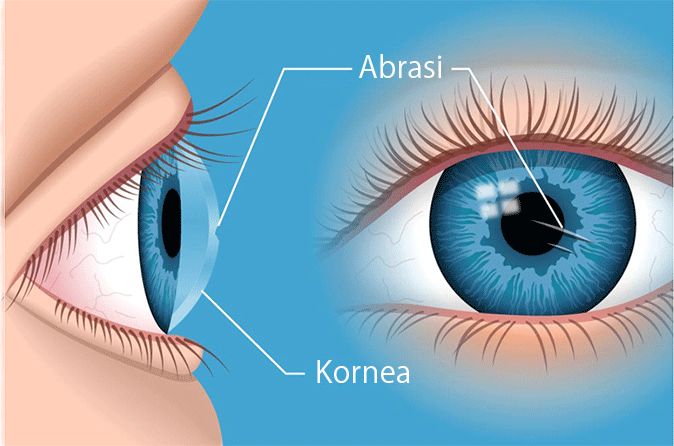 Ilustrasi abrasi kornea