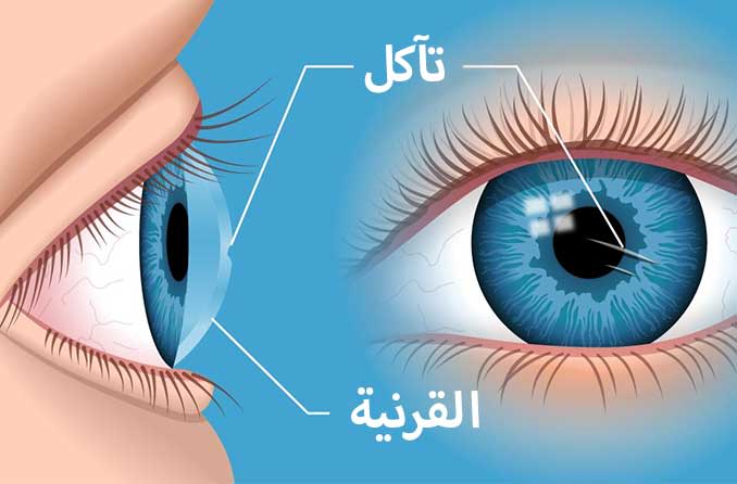 خدش القرنية كيفية علاج العين المصابة بخدش