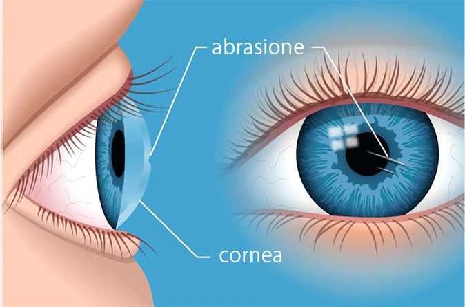 Illustrazione dell'abrasione corneale