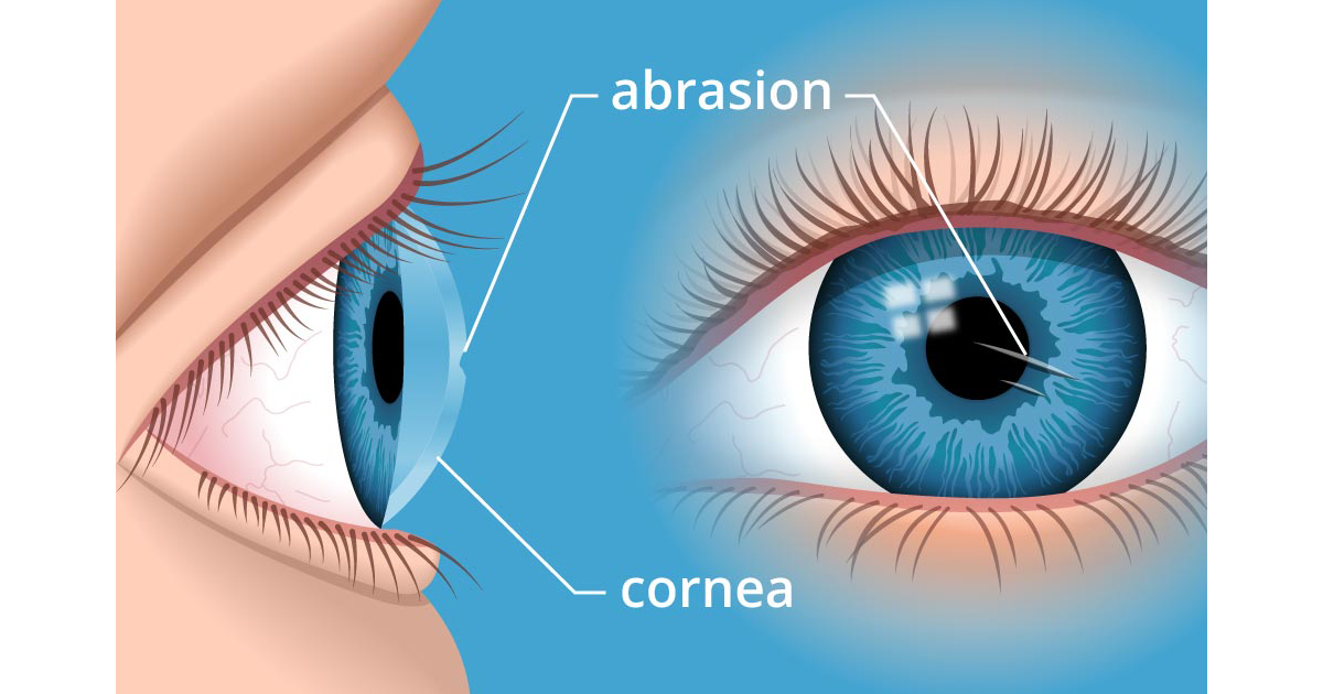 What Is Corneal Disease? - All About Vision