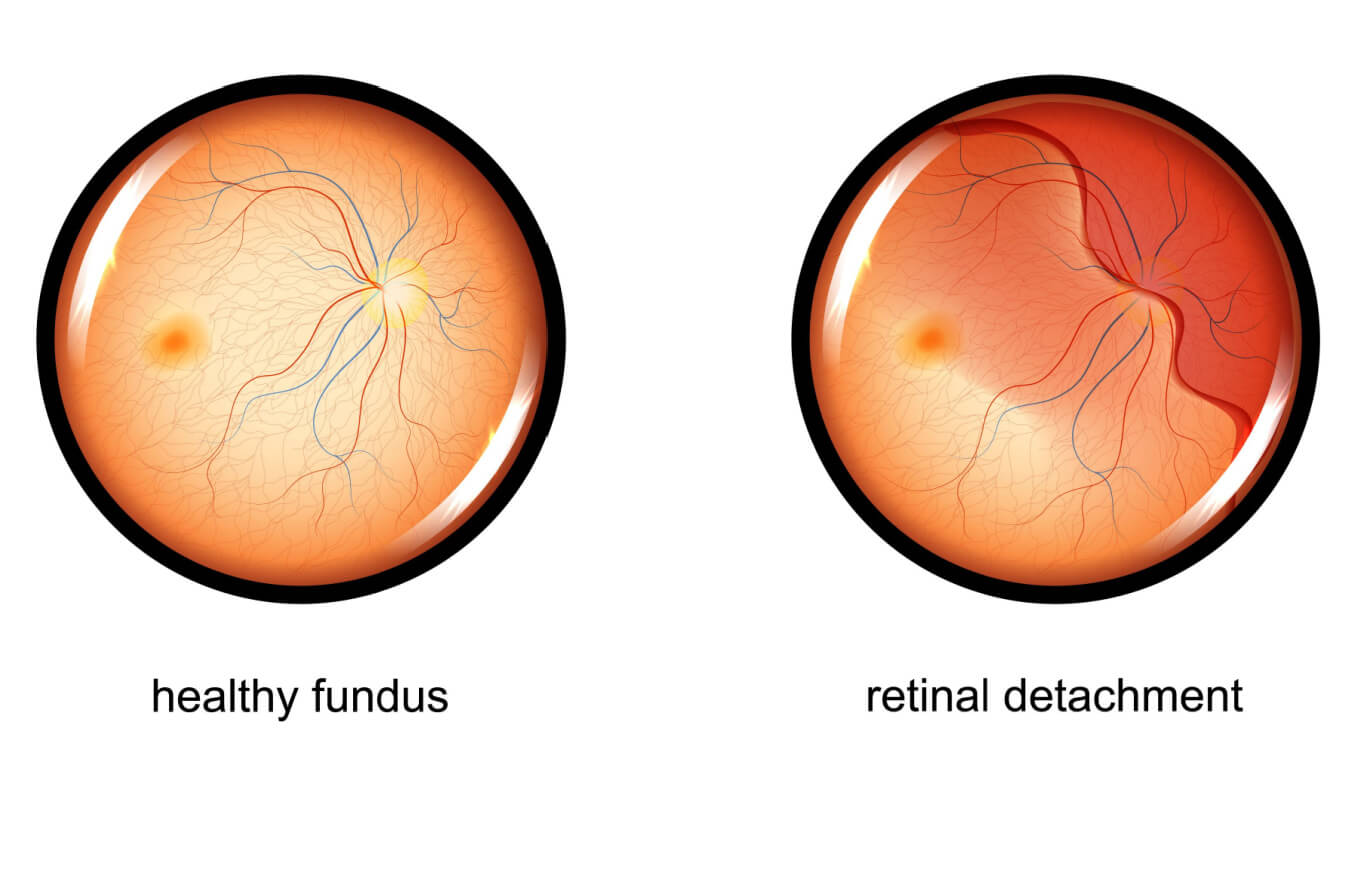 Retinal tear v. a normal eye.
