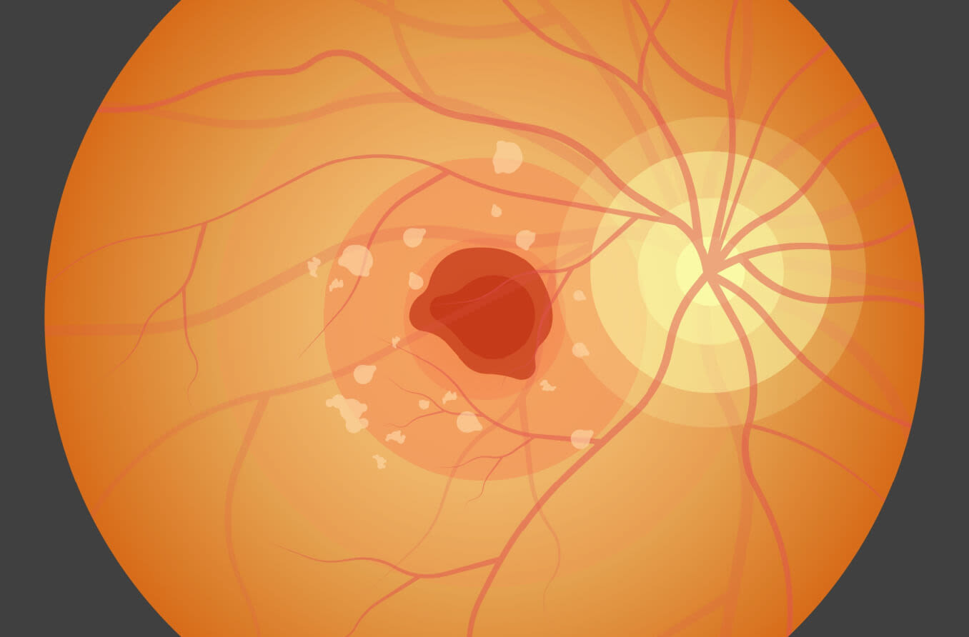 Perda de visão associada com a doença de Stargardt