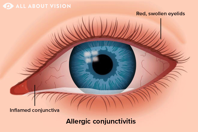 Types Of Conjunctivitis Pink Eye All About Vision
